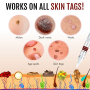 WipeOff™Tag & Moles Remover( Buy one Get 1 Free)